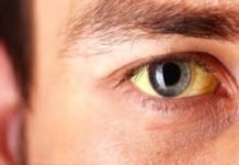 തൃശൂര് ജില്ലയില് മഞ്ഞപ്പിത്തം പടരുന്നു; നൂറിലേറെ പേര്ക്ക് രോഗം സ്ഥിരീകരിച്ചു